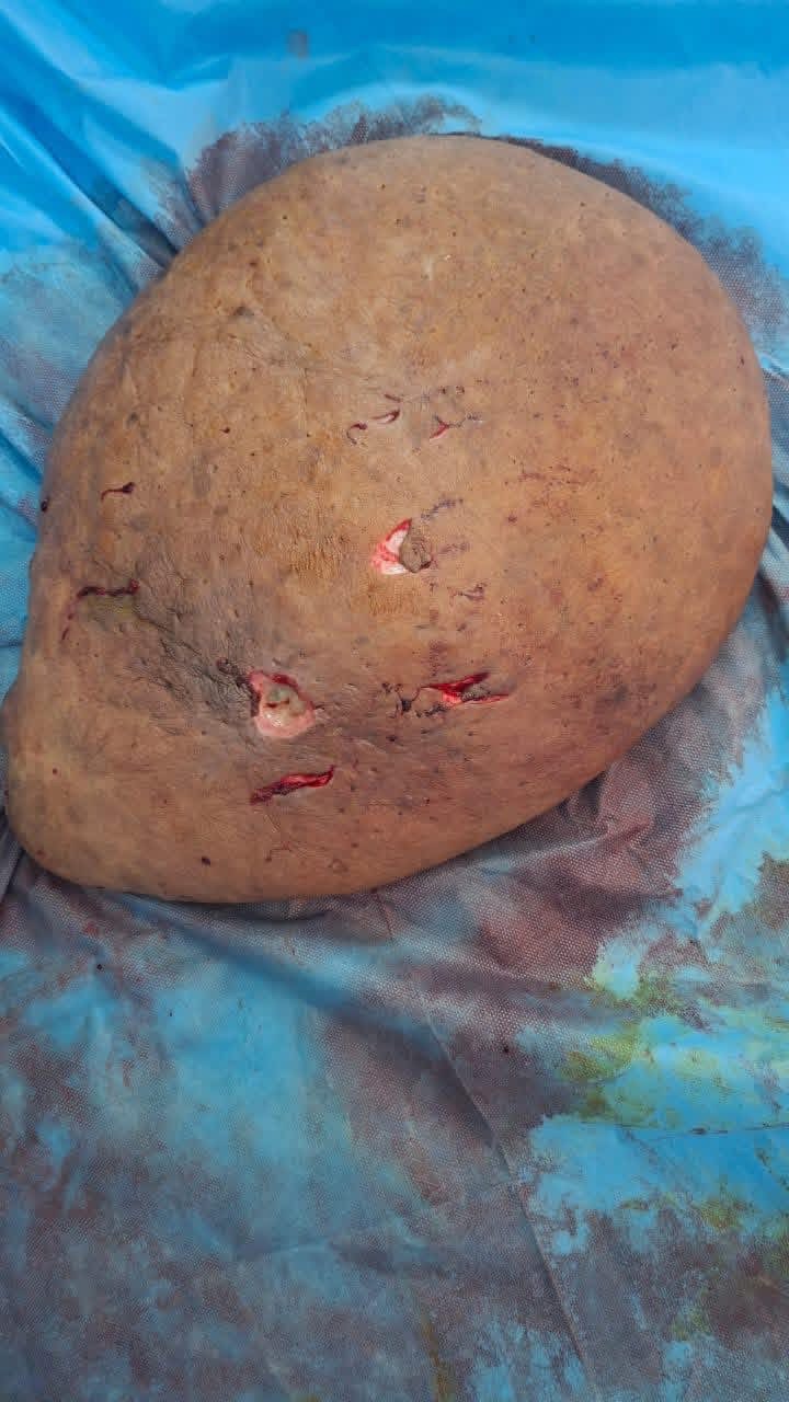 صورة الورم المستأصل 